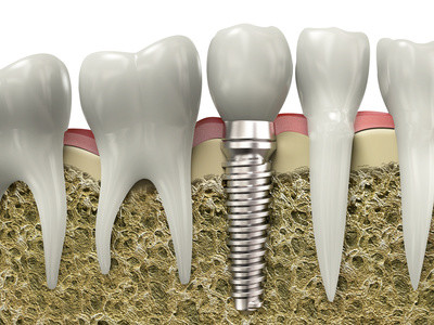 implantate flexdent ulm zahnärzte